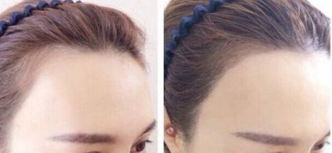 杭州疤痕整形哪家醫(yī)院好？選擇哪個醫(yī)院更靠譜？