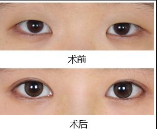 鄭州去黑點哪家醫(yī)院好？揭秘最受歡迎的黑點去除醫(yī)院