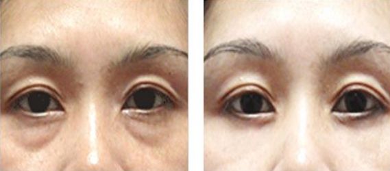 深圳哪家醫(yī)院祛色斑好-四大祛斑療法解密，選擇最適合你的祛斑方式