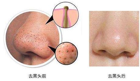 杭州哪家美容醫(yī)院吸脂效果最佳？