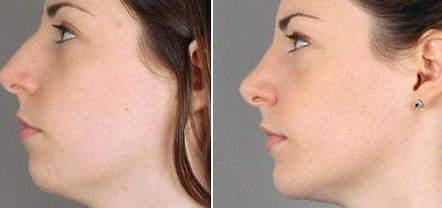 【2023邯鄲祛痘印醫(yī)院哪家好？專家推薦排行榜】