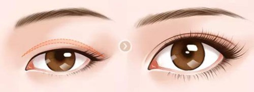 武漢美立方的胡江偉如何進(jìn)行雙眼皮手術(shù)？