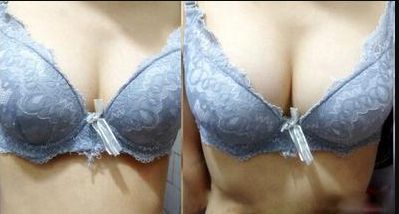 廣州哪家醫(yī)院的乳頭凹陷術(shù)效果好？