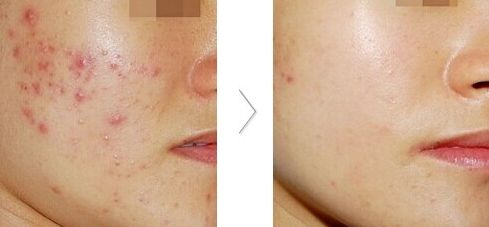 大連雙眼皮整形醫(yī)院哪家好？推薦大連哪家整形雙眼皮效果最佳