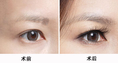 北京八大處醫(yī)院大牌醫(yī)生推薦！專(zhuān)治雙眼皮！