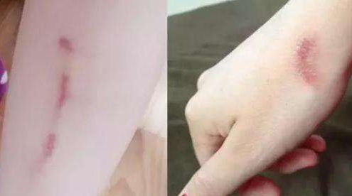 邵陽去痘去斑哪家醫(yī)院好？選擇正規(guī)醫(yī)療機(jī)構(gòu)，解決邵陽去痘去斑問題