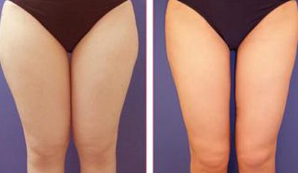 杭州去除雀斑哪家醫(yī)院好？天堂醫(yī)美專業(yè)美容師傾情解答！