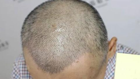 北京哪位醫(yī)生在拉皮手術(shù)方面有口碑？