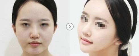 溫州哪家醫(yī)院祛除疤痕效果最佳，專家推薦！