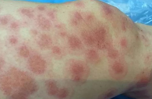 杜太超的鼻部整形效果驚艷，細(xì)節(jié)設(shè)計(jì)精湛！或杜太超的鼻子整形術(shù)成功塑造出迷人的面容