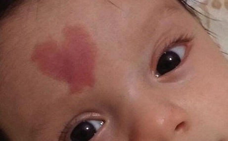 上海第九人民醫(yī)院張余光鼻翼修復(fù)手術(shù)結(jié)果如何評價