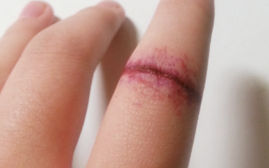 【2023無錫去眼袋最優(yōu)醫(yī)院Top5】去眼袋無錫哪家醫(yī)院好