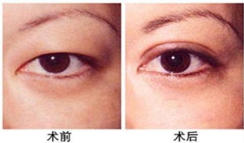 杭州做激光眼科手術(shù)哪家醫(yī)院好，專家推薦