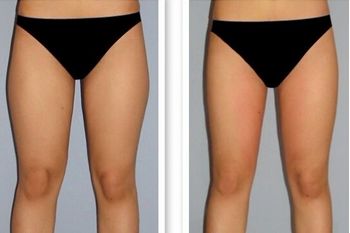 南昌哪家全科醫(yī)院有最好的外切眼袋手術(shù)效果？