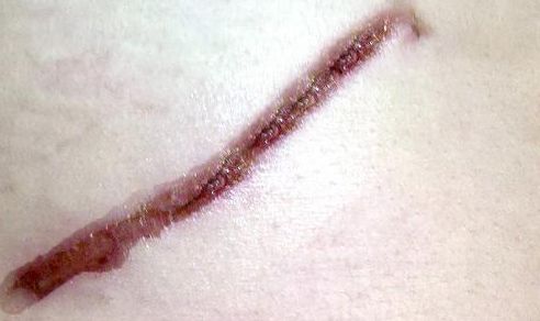 鐳射溶脂杭州哪家醫(yī)院好？專家推薦排名前三的權(quán)威醫(yī)院