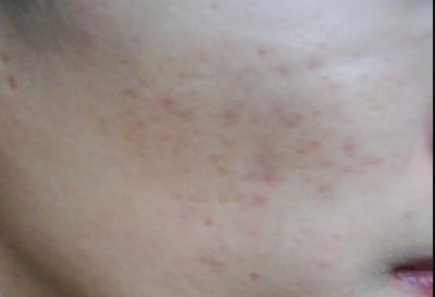 寧波祛疤哪家醫(yī)院哪里好？專家告訴你最佳選擇！