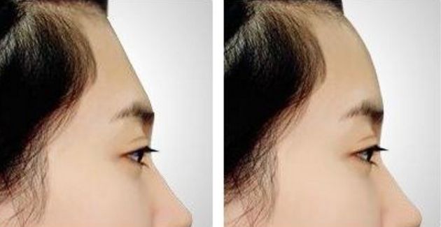 南京割雙眼皮哪家醫(yī)院效果好？