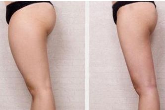 佛山哪家醫(yī)院治痘坑痘印效果好？推薦一家靠譜的醫(yī)院！