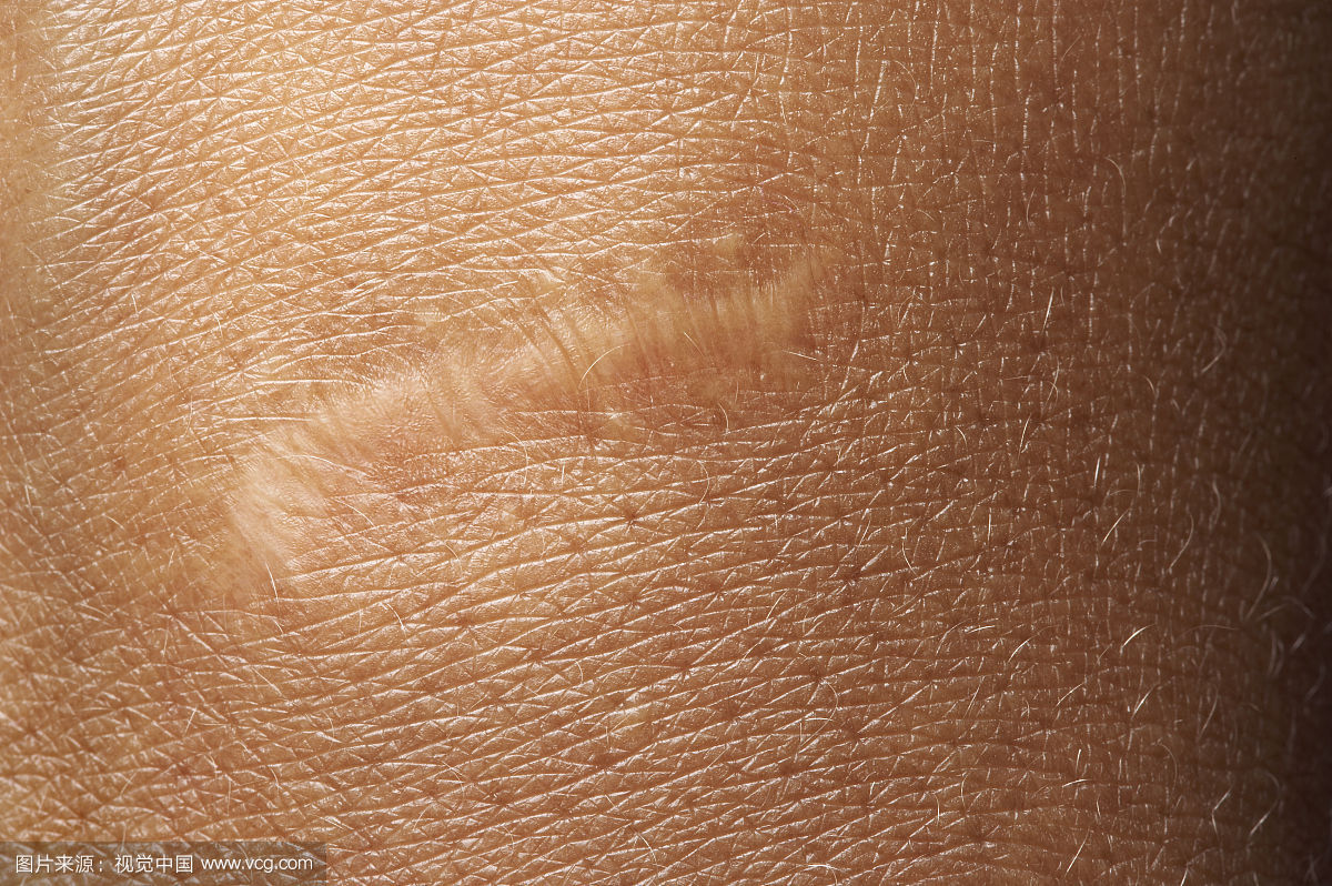 2023南昌疤痕性禿發(fā)口碑榜前10名的專家(李超、任鎮(zhèn)雄、李丹醫(yī)生技術(shù)點(diǎn)評(píng)好不好~)