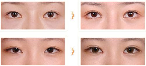 2023煙臺(tái)外眼角懸吊術(shù)前十專(zhuān)家排行(李岳令、張洪達(dá)、張鵬前十詳細(xì)點(diǎn)評(píng))