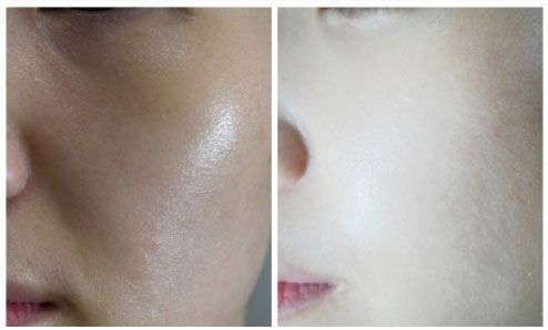 秦皇島祛斑哪家醫(yī)院好？推薦秦皇島哪家醫(yī)院祛斑效果好