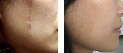 廣州抽脂手術(shù)哪家醫(yī)院最靠譜？