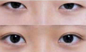 秦皇島雙眼皮哪家做的好？選擇前必看！
