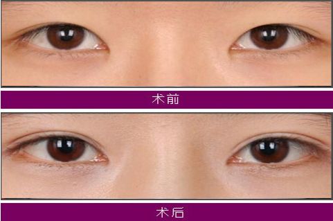 大連注射玻尿酸哪家醫(yī)院技術(shù)好，效果持久？