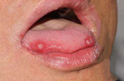 2023六安玻尿酸填充眼角皺紋專家前10位上榜名單(趙遵江、李成虎、夏利娟千萬別錯過！)