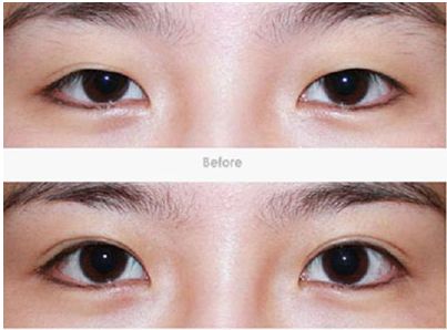 【2023年吉林市最佳割雙眼皮醫(yī)院推薦】解析吉林市哪家割雙眼皮好