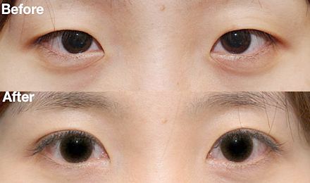 2023深圳黃金微針去除口周紋醫(yī)生綜合實(shí)力排行榜(鄭瑜璠、吳曉玲、劉彤大勢醫(yī)美重磅來襲)