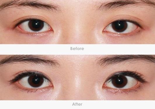 深圳哪家專(zhuān)業(yè)去黑眼圈機(jī)構(gòu)靠譜？