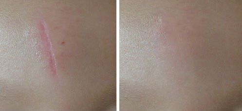 鄭州哪家醫(yī)院激光做的好？找尋專業(yè)！領(lǐng)先的鄭州醫(yī)院激光治療推薦