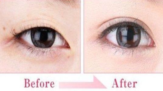 蘇州雙眼皮哪家做的好？專業(yè)攻略與醫(yī)師推薦