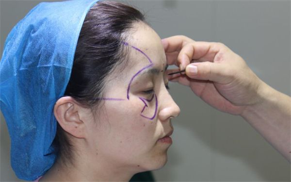 南寧哪家醫(yī)院痘印治療效果最佳？