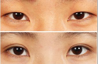 南寧去痘坑哪家醫(yī)院好？揭秘南寧市治療痘坑的頂尖專家團(tuán)隊(duì)！