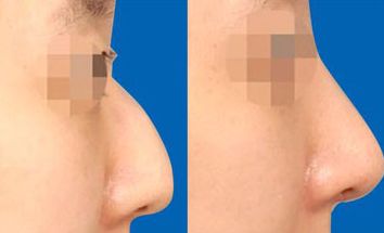 南京鼻綜合修復(fù)醫(yī)院哪家好？找準(zhǔn)南京鼻部整形中心，為你解答！