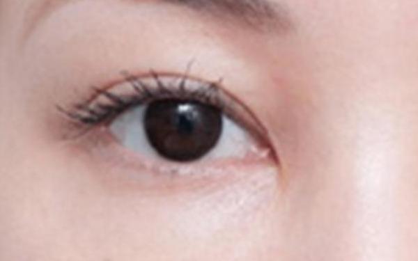 廣州哪家醫(yī)院做隆胸手術(shù)技術(shù)高？醫(yī)生資深經(jīng)驗來看詳細(xì)介紹！