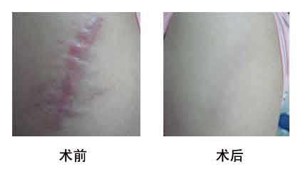 2023寧波口周紋激光去除強榜前10名的醫(yī)生(盧仁鎬、李永俊、陳樂琴正規(guī)良心推薦)