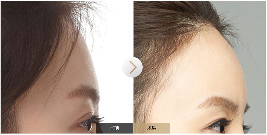 南寧點(diǎn)痣需求旺盛，哪家醫(yī)院是最受歡迎的？