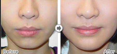 上海做雙眼皮哪家好醫(yī)院？專家評選2023年最佳雙眼皮醫(yī)院