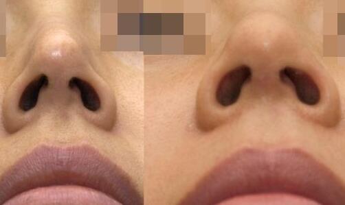 靳小雷雙眼皮修復(fù)手術(shù)的完美案例分享，期待您的見(jiàn)證