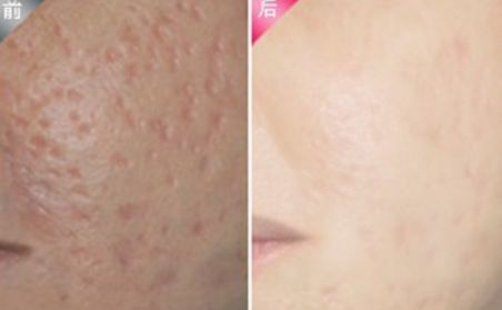 杭州做雙眼皮哪家好？2023年杭州雙眼皮整形醫(yī)院綜合排名指南拆解