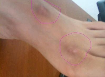 溫州哪家醫(yī)院做雙眼皮手術(shù)好？