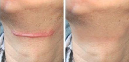 杭州市疤痕醫(yī)院哪家好？無痕祛疤，專業(yè)技術(shù)讓你恢復(fù)自信！