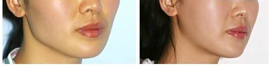 合肥假體隆胸哪家醫(yī)院好？術(shù)后效果如何？