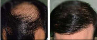 寧波哪家醫(yī)院割雙眼皮效果好、經(jīng)驗(yàn)豐富，值得推薦？