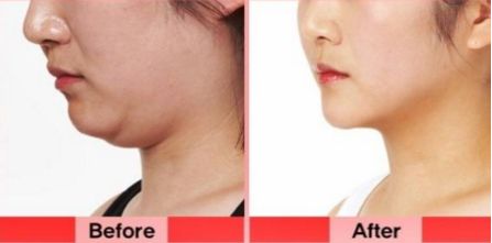 洛陽(yáng)雙眼皮修復(fù)哪家好？挑選專(zhuān)業(yè)技術(shù)實(shí)力強(qiáng)的醫(yī)療機(jī)構(gòu)