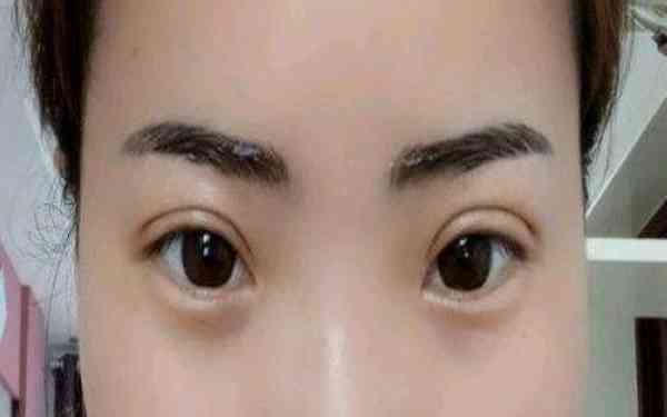 北京京韓醫(yī)院?jiǎn)虗圮娮泽w脂肪隆胸費(fèi)用及效果探析