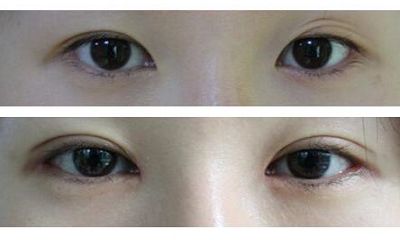 長沙哪家醫(yī)院專業(yè)去痘印效果好，讓你的肌膚恢復(fù)光滑無瑕